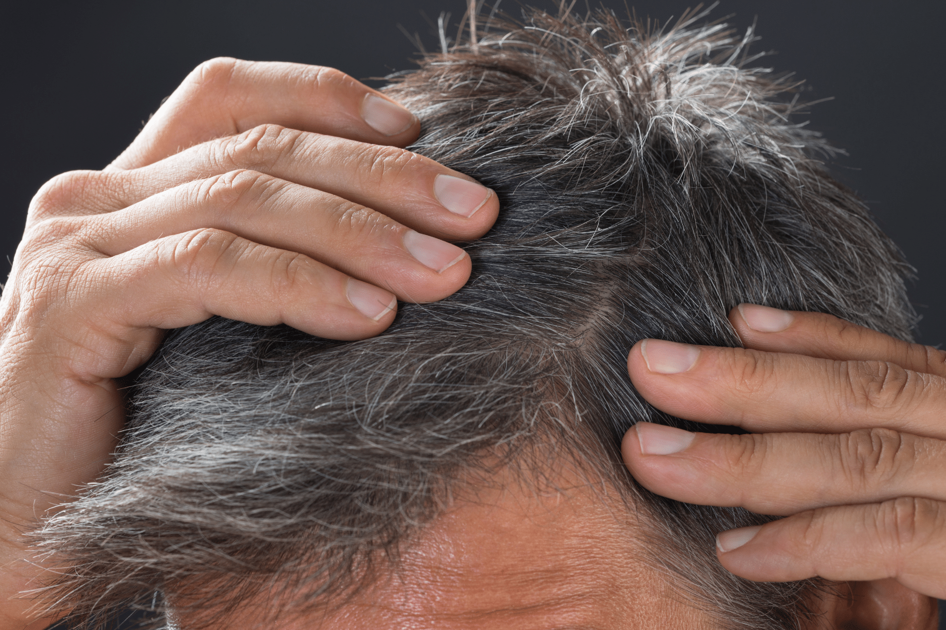 homem com cabelo grisalho que quer fazer transplante capilar