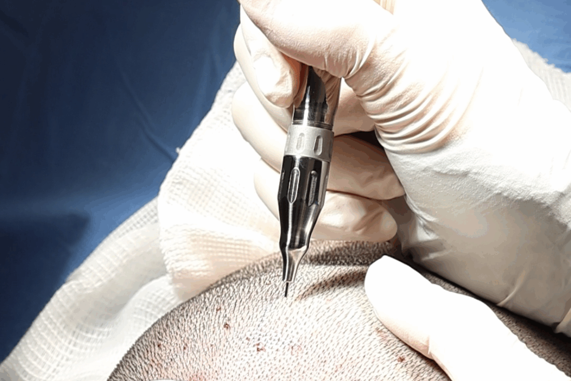 Dr Julio Pierezan utilizando Mamba, Caneta Extratora no Transplante Capilar