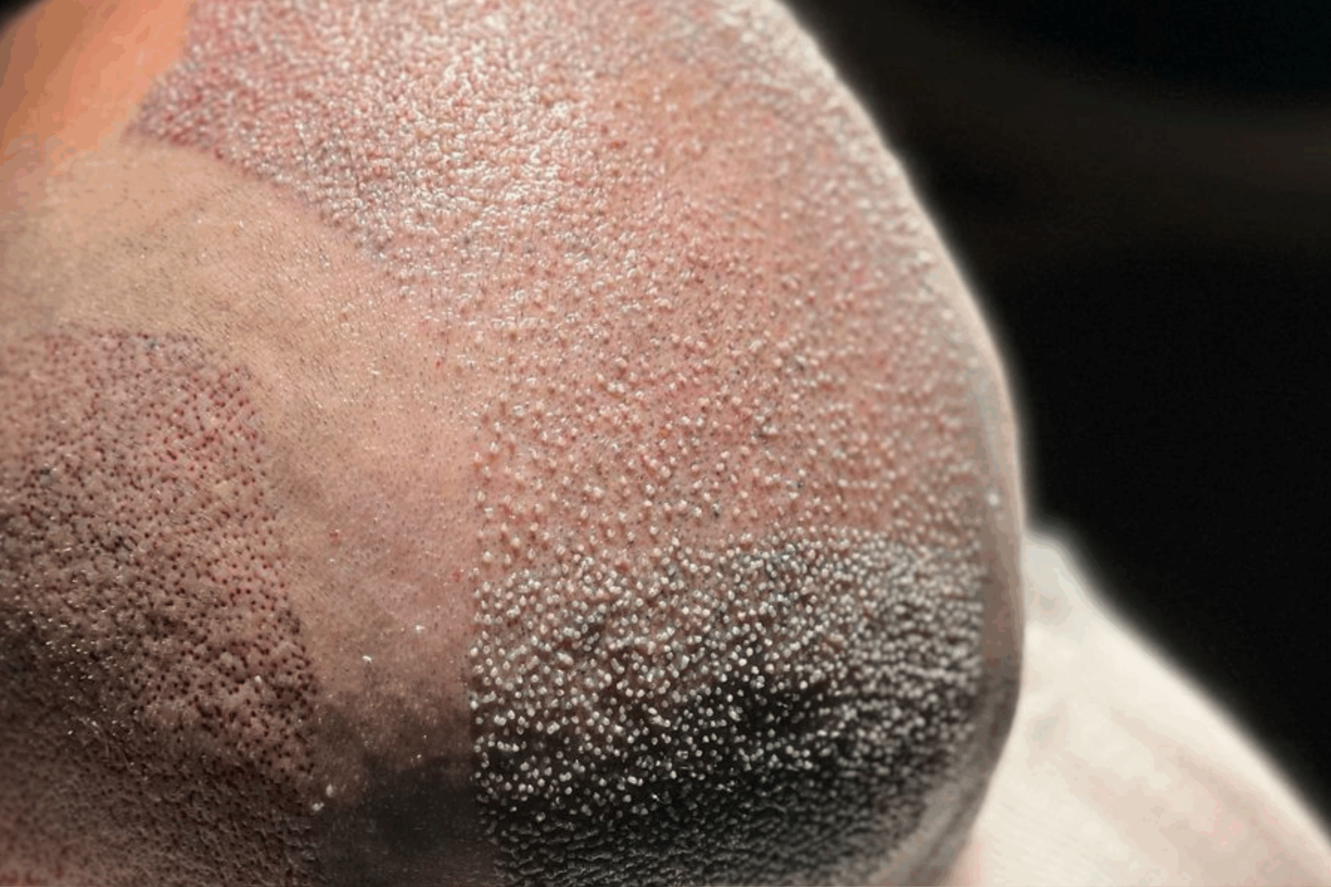 Resultado pós-transplante capilar com técnica FUE