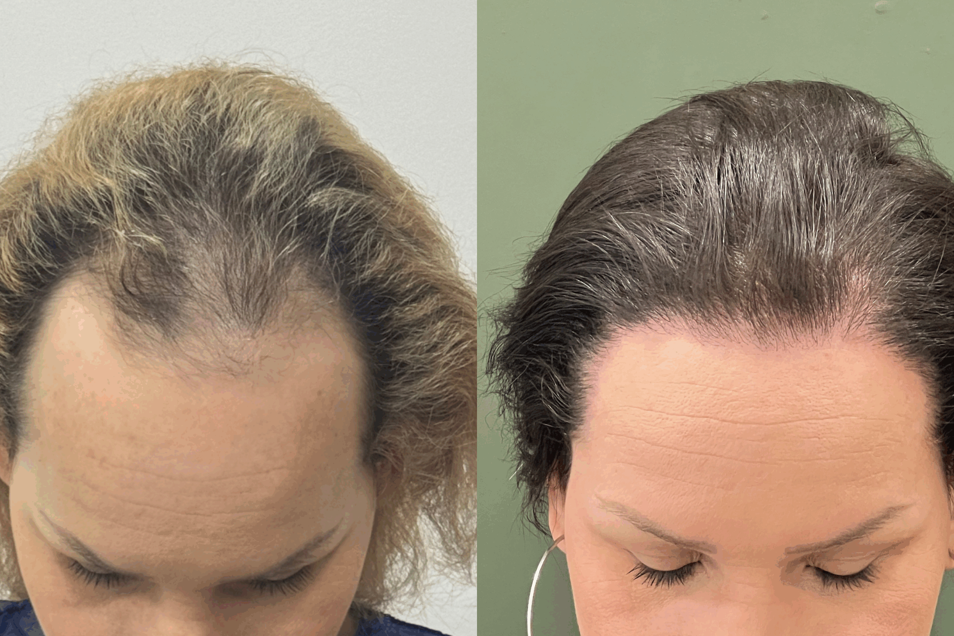 Antes e Depois do Transplante Capilar de Mulher Trans na Clínica Pierezan